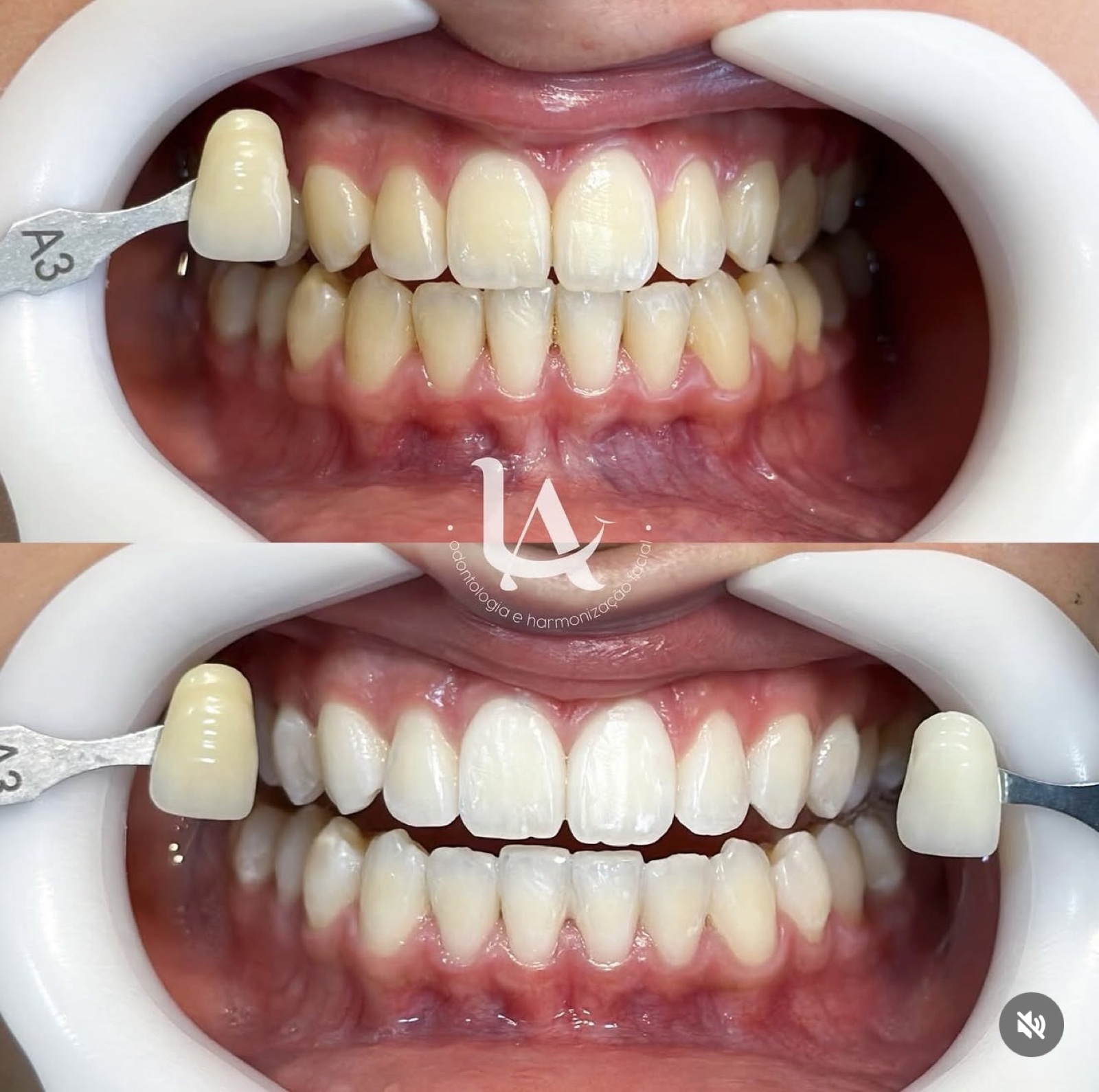 Clareamento dental