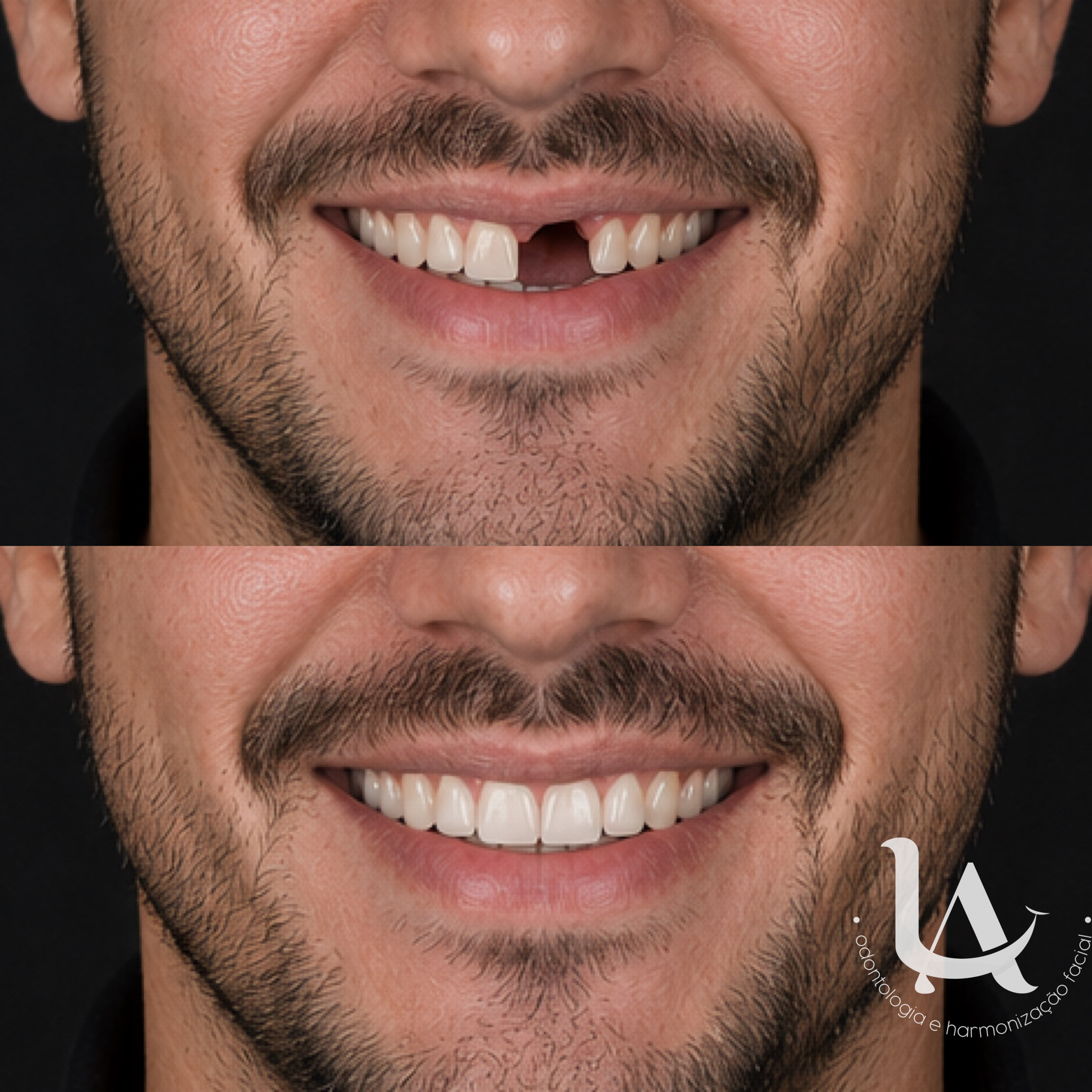 Implantes dentários
